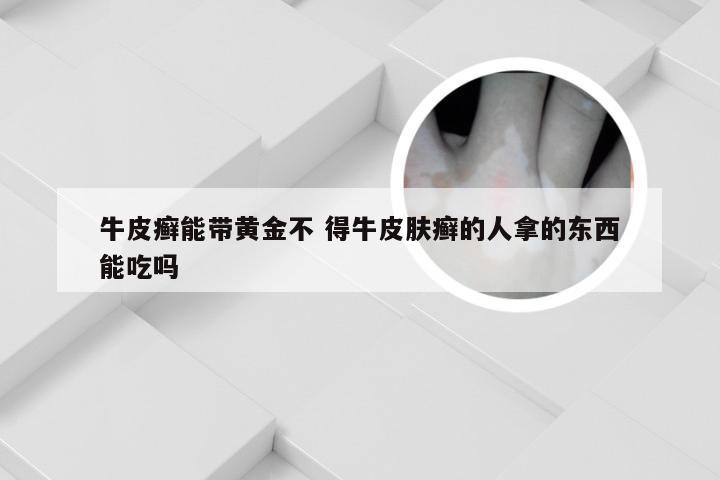 牛皮癣能带黄金不 得牛皮肤癣的人拿的东西能吃吗