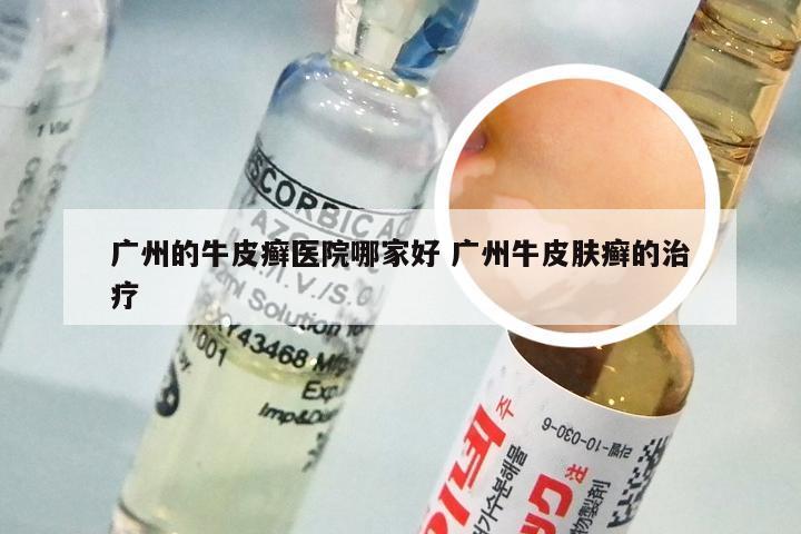 广州的牛皮癣医院哪家好 广州牛皮肤癣的治疗
