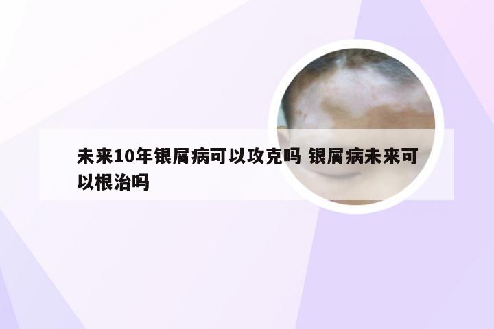 未来10年银屑病可以攻克吗 银屑病未来可以根治吗
