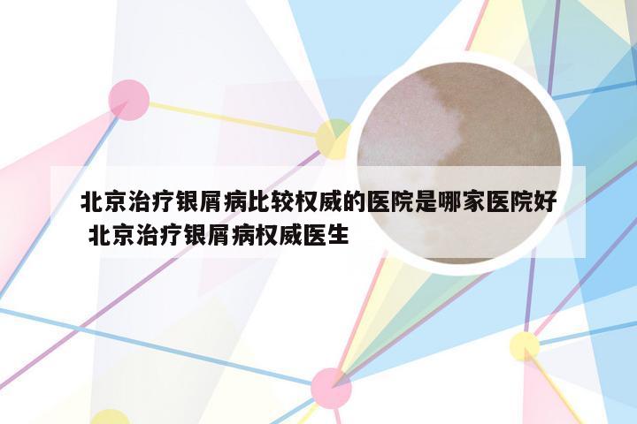 北京治疗银屑病比较权威的医院是哪家医院好 北京治疗银屑病权威医生