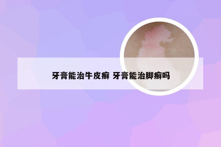 牙膏能治牛皮癣 牙膏能治脚癣吗