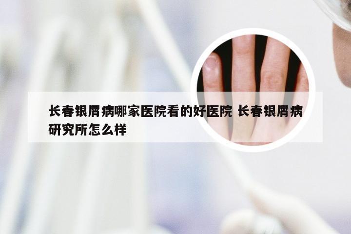长春银屑病哪家医院看的好医院 长春银屑病研究所怎么样