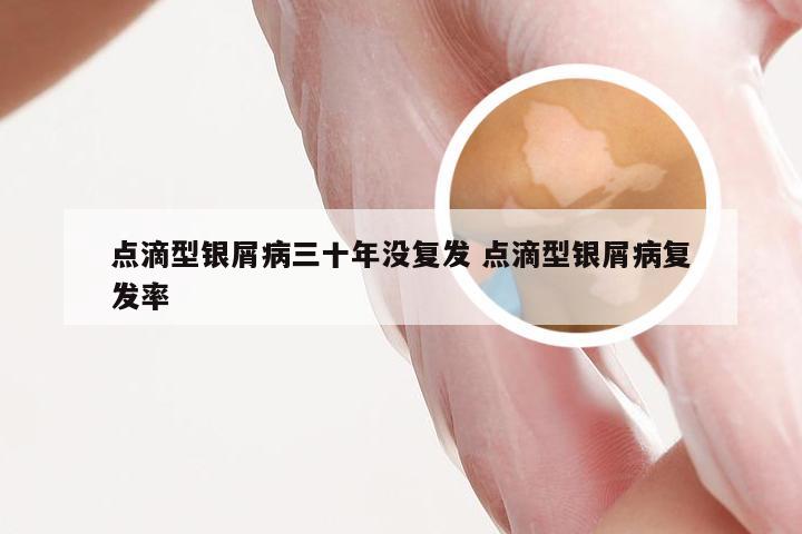 点滴型银屑病三十年没复发 点滴型银屑病复发率