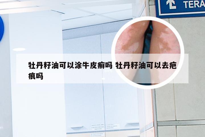 牡丹籽油可以涂牛皮癣吗 牡丹籽油可以去疤痕吗