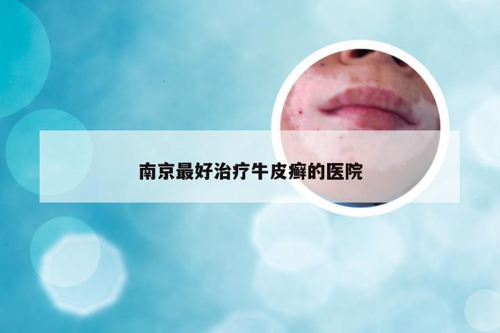 南京最好治疗牛皮癣的医院