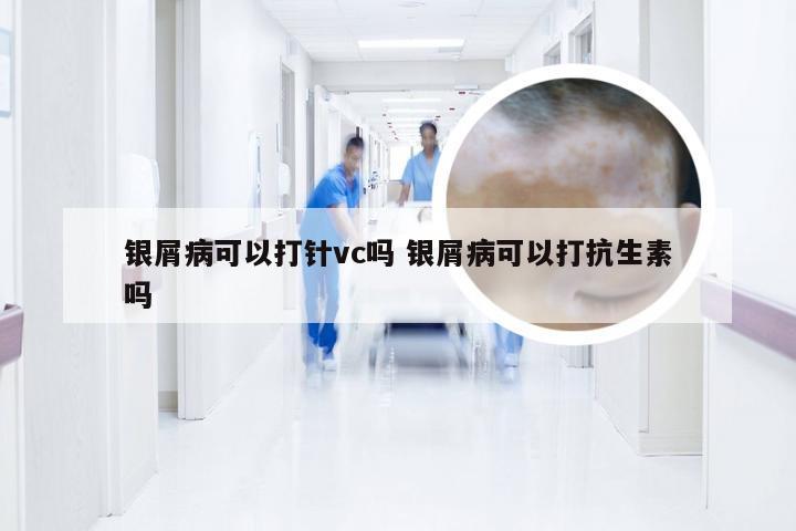 银屑病可以打针vc吗 银屑病可以打抗生素吗