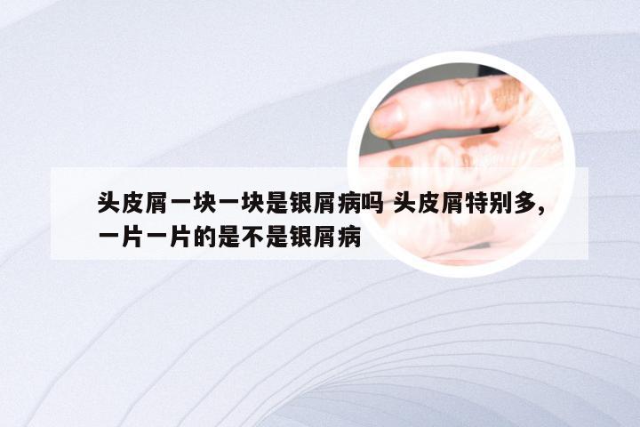头皮屑一块一块是银屑病吗 头皮屑特别多,一片一片的是不是银屑病