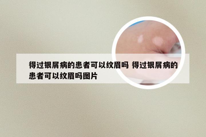 得过银屑病的患者可以纹眉吗 得过银屑病的患者可以纹眉吗图片