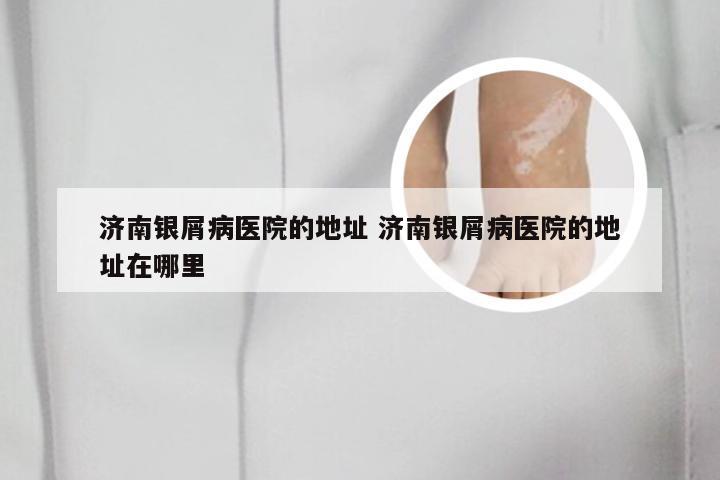济南银屑病医院的地址 济南银屑病医院的地址在哪里
