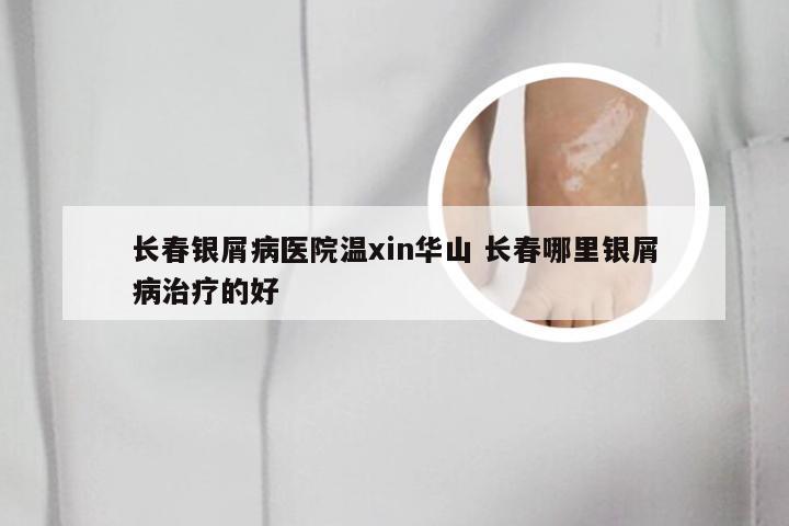 长春银屑病医院温xin华山 长春哪里银屑病治疗的好