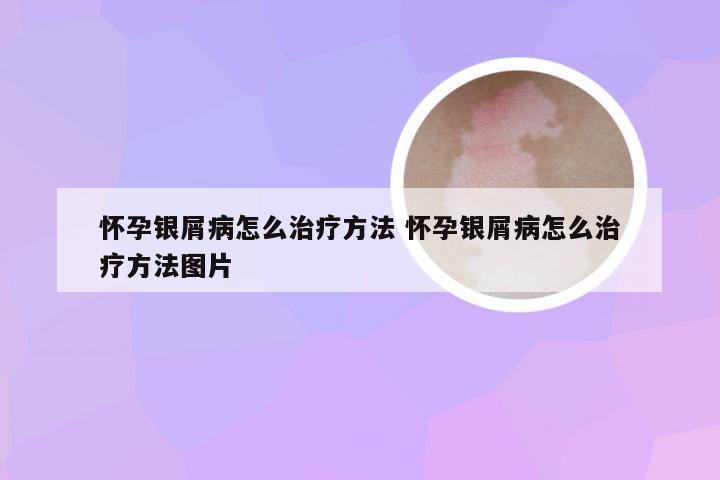 怀孕银屑病怎么治疗方法 怀孕银屑病怎么治疗方法图片
