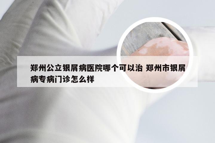 郑州公立银屑病医院哪个可以治 郑州市银屑病专病门诊怎么样