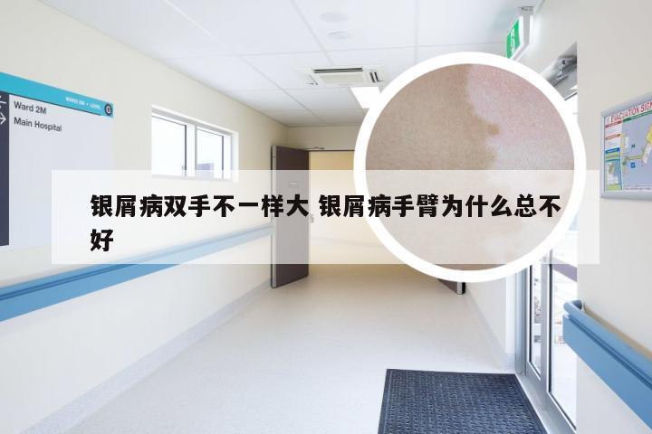 银屑病双手不一样大 银屑病手臂为什么总不好
