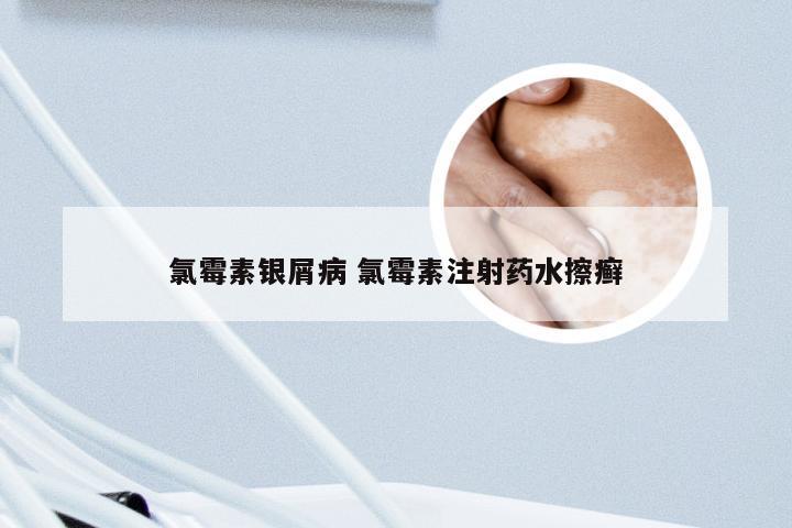 氯霉素银屑病 氯霉素注射药水擦癣