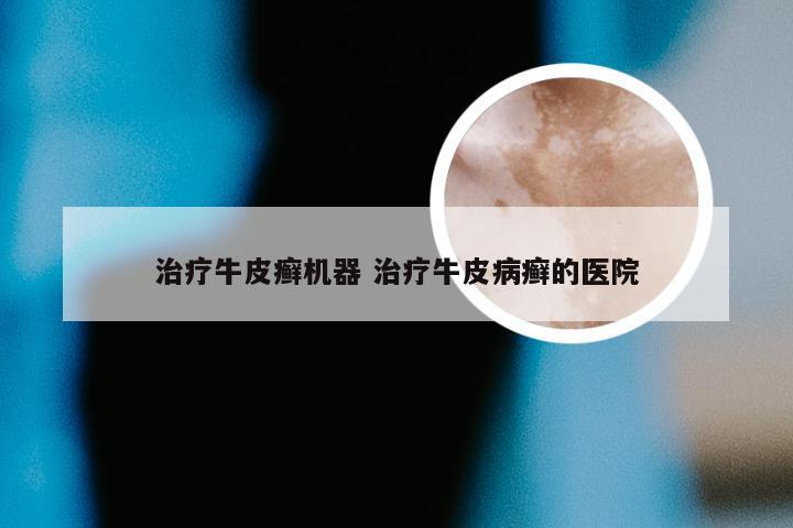 治疗牛皮癣机器 治疗牛皮病癣的医院