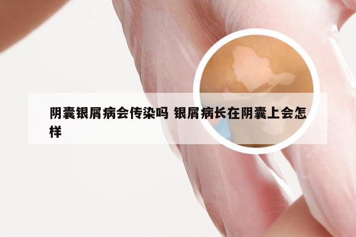 阴囊银屑病会传染吗 银屑病长在阴囊上会怎样