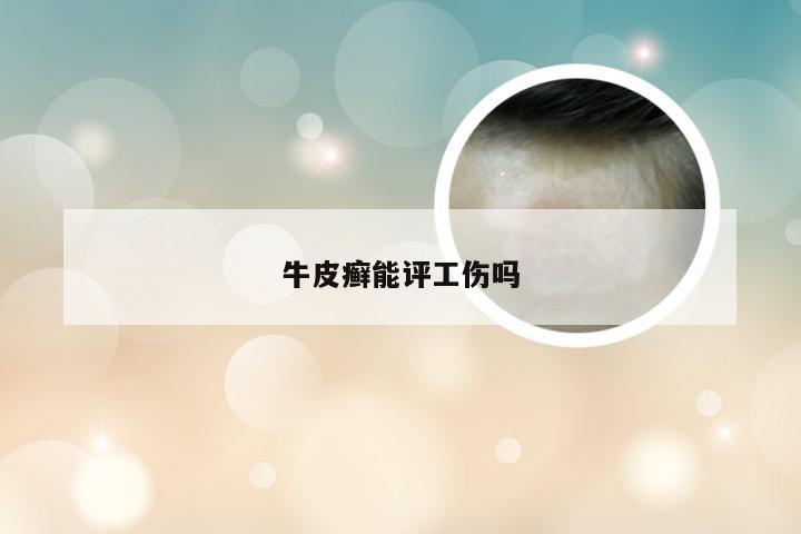 牛皮癣能评工伤吗