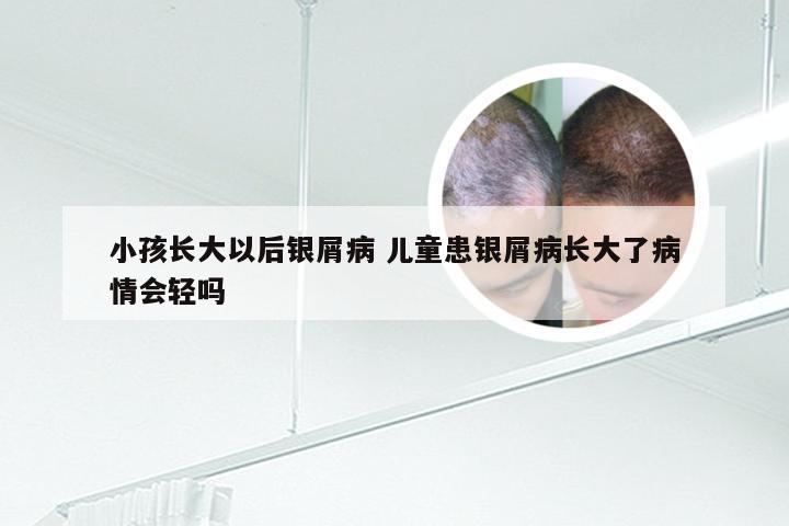 小孩长大以后银屑病 儿童患银屑病长大了病情会轻吗