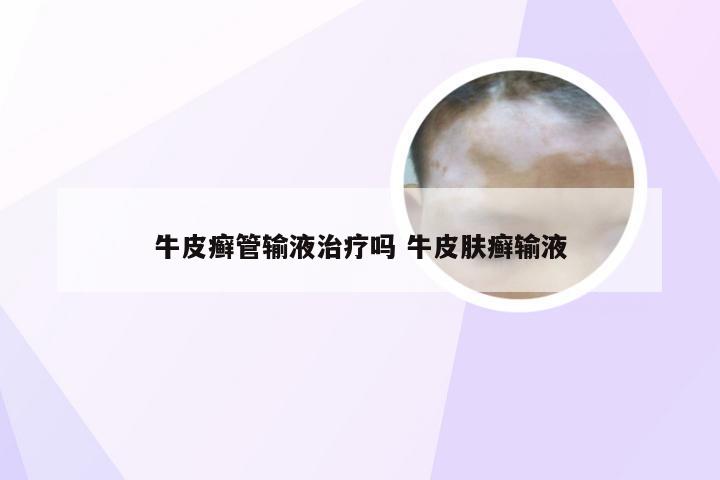 牛皮癣管输液治疗吗 牛皮肤癣输液