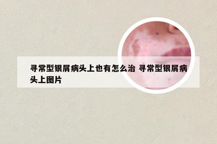 寻常型银屑病头上也有怎么治 寻常型银屑病头上图片