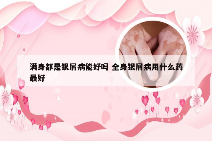 满身都是银屑病能好吗 全身银屑病用什么药最好