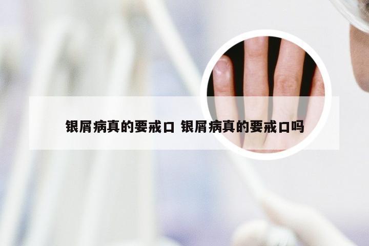 银屑病真的要戒口 银屑病真的要戒口吗