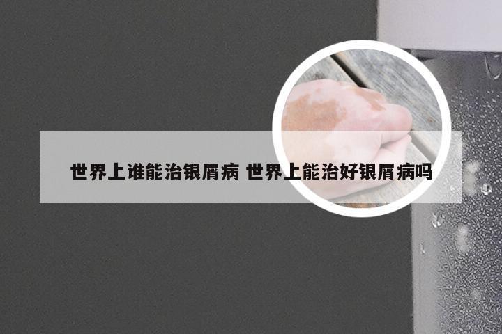 世界上谁能治银屑病 世界上能治好银屑病吗