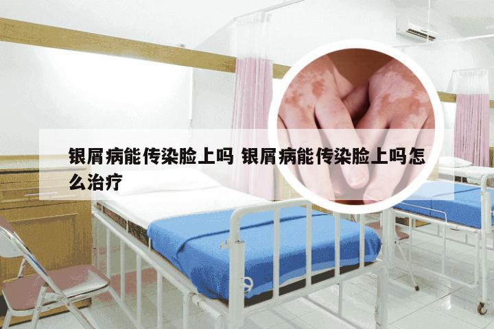 银屑病能传染脸上吗 银屑病能传染脸上吗怎么治疗