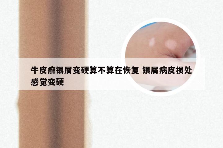 牛皮癣银屑变硬算不算在恢复 银屑病皮损处感觉变硬