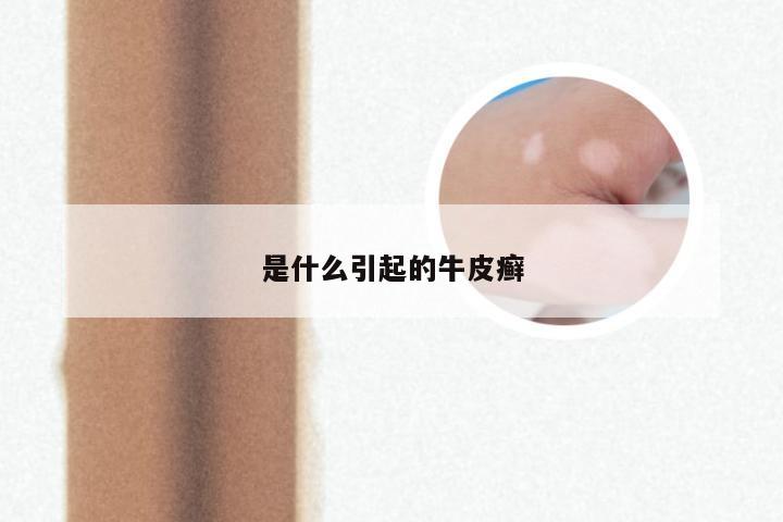 是什么引起的牛皮癣