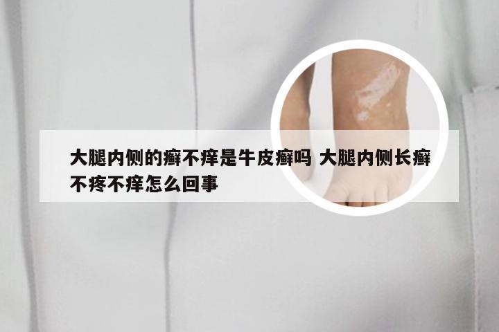 大腿内侧的癣不痒是牛皮癣吗 大腿内侧长癣不疼不痒怎么回事