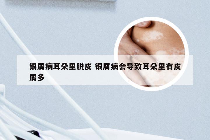 银屑病耳朵里脱皮 银屑病会导致耳朵里有皮屑多
