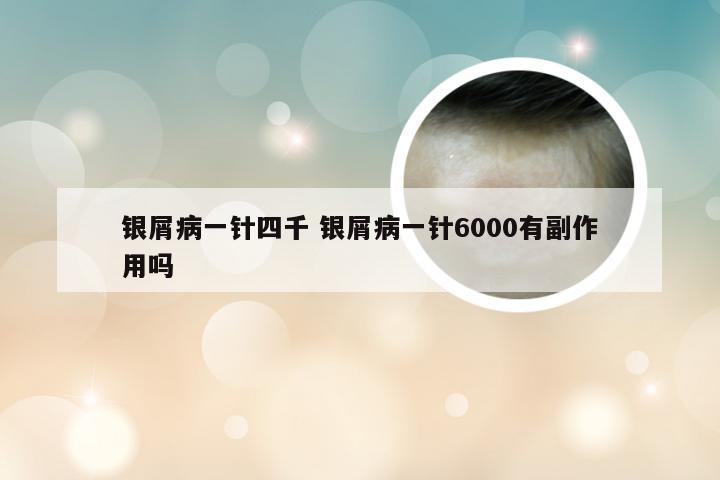 银屑病一针四千 银屑病一针6000有副作用吗