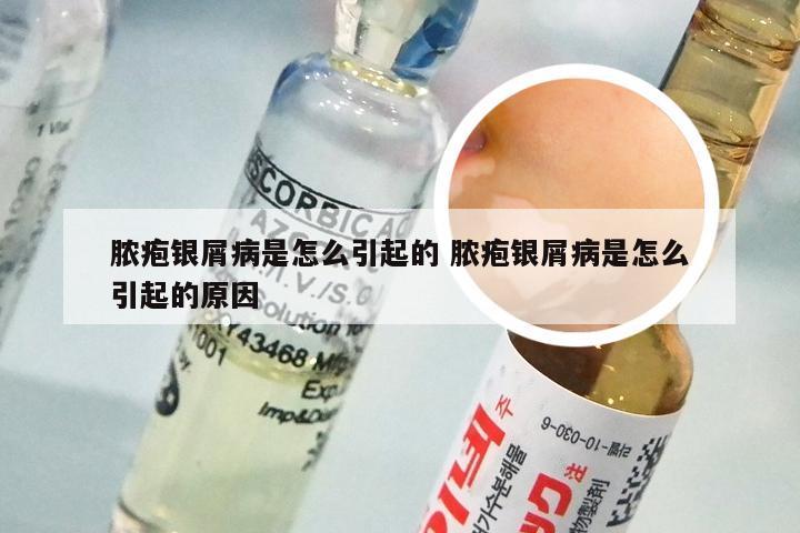 脓疱银屑病是怎么引起的 脓疱银屑病是怎么引起的原因