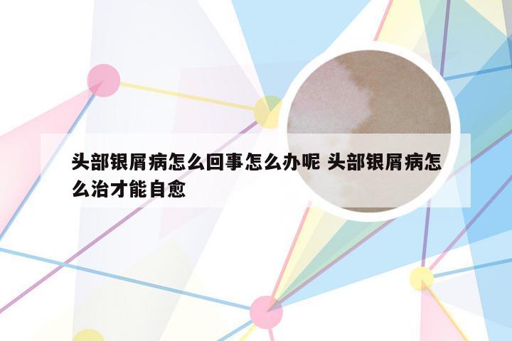 头部银屑病怎么回事怎么办呢 头部银屑病怎么治才能自愈
