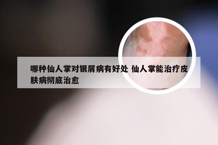 哪种仙人掌对银屑病有好处 仙人掌能治疗皮肤病彻底治愈
