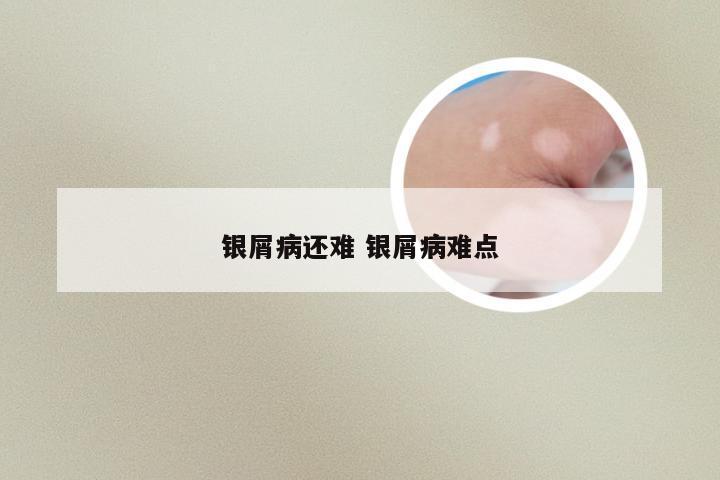 银屑病还难 银屑病难点