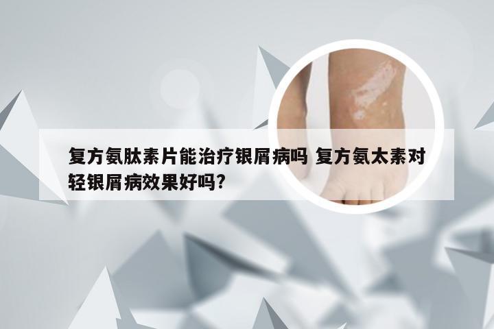 复方氨肽素片能治疗银屑病吗 复方氨太素对轻银屑病效果好吗?
