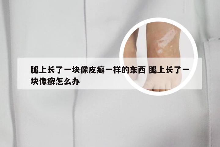 腿上长了一块像皮癣一样的东西 腿上长了一块像癣怎么办