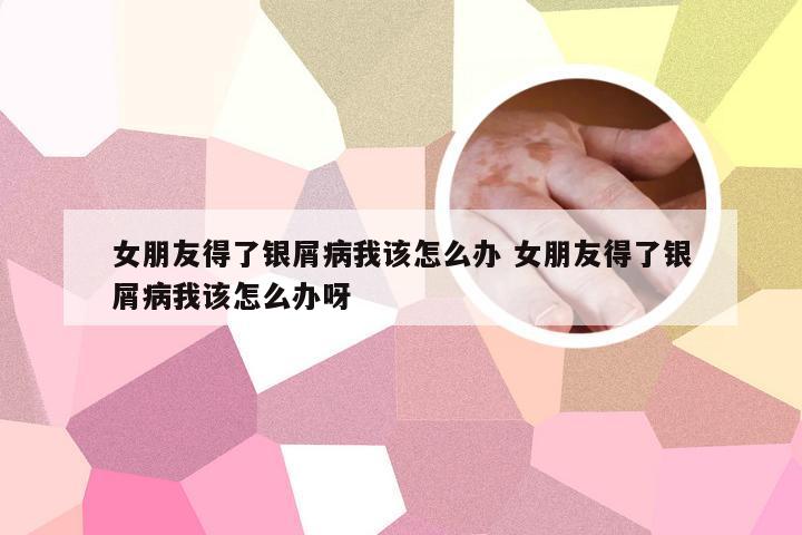 女朋友得了银屑病我该怎么办 女朋友得了银屑病我该怎么办呀