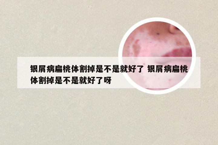 银屑病扁桃体割掉是不是就好了 银屑病扁桃体割掉是不是就好了呀