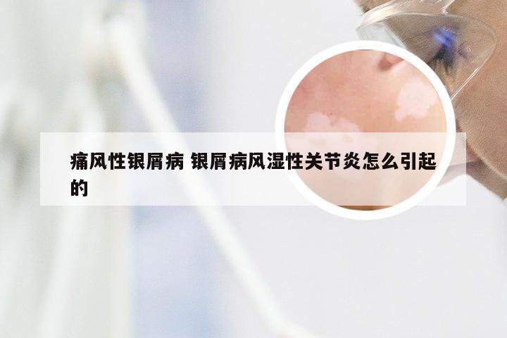 痛风性银屑病 银屑病风湿性关节炎怎么引起的