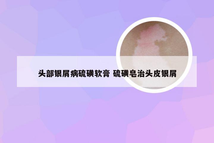 头部银屑病硫磺软膏 硫磺皂治头皮银屑
