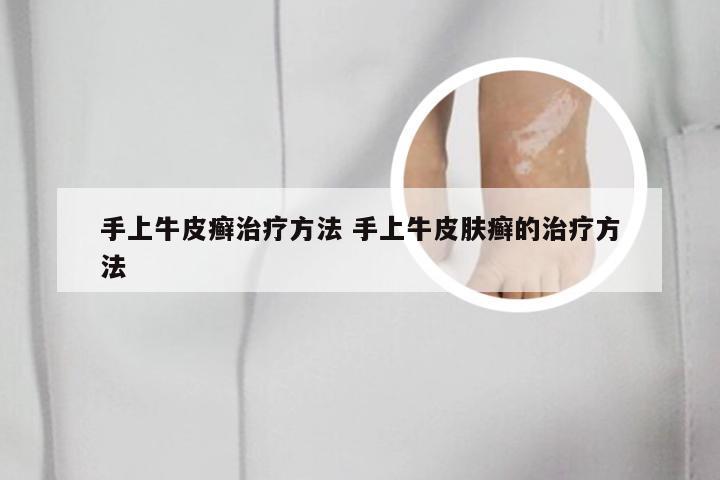 手上牛皮癣治疗方法 手上牛皮肤癣的治疗方法