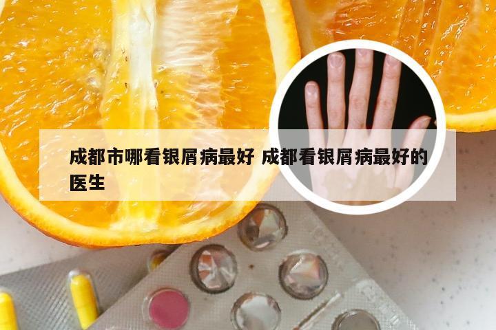 成都市哪看银屑病最好 成都看银屑病最好的医生