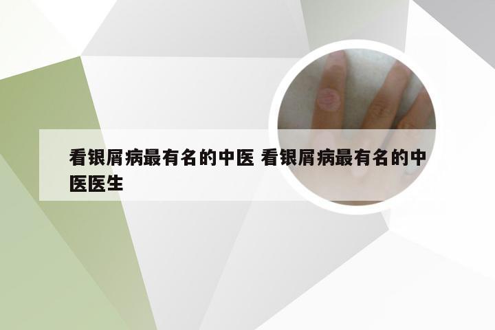 看银屑病最有名的中医 看银屑病最有名的中医医生