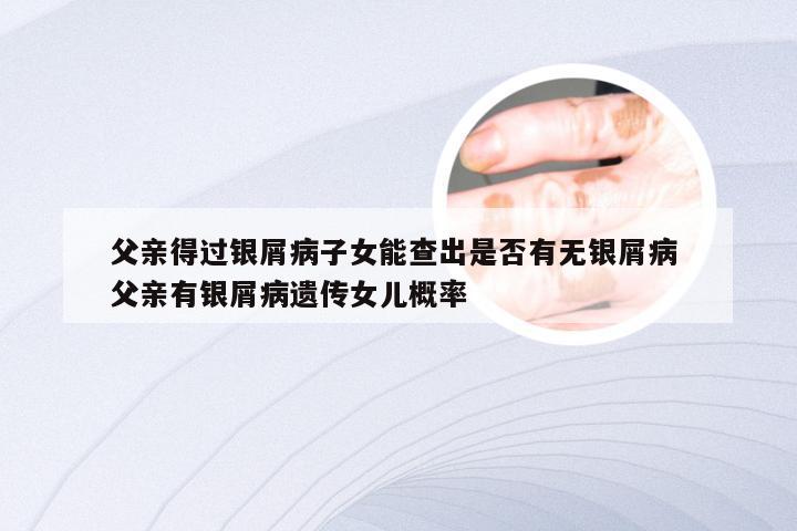 父亲得过银屑病子女能查出是否有无银屑病 父亲有银屑病遗传女儿概率