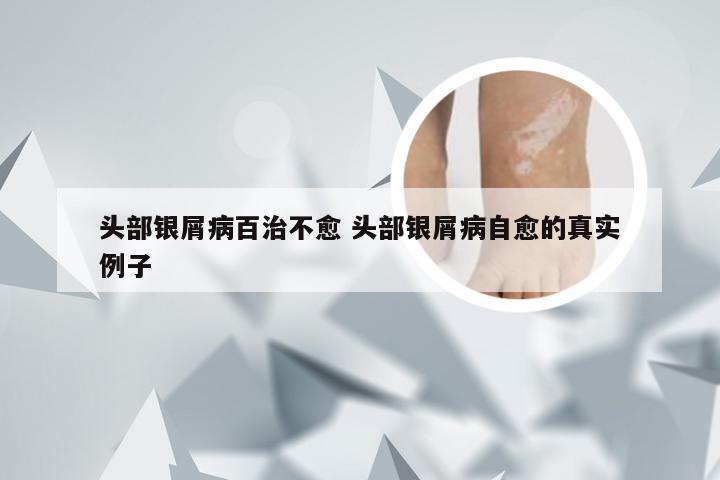 头部银屑病百治不愈 头部银屑病自愈的真实例子