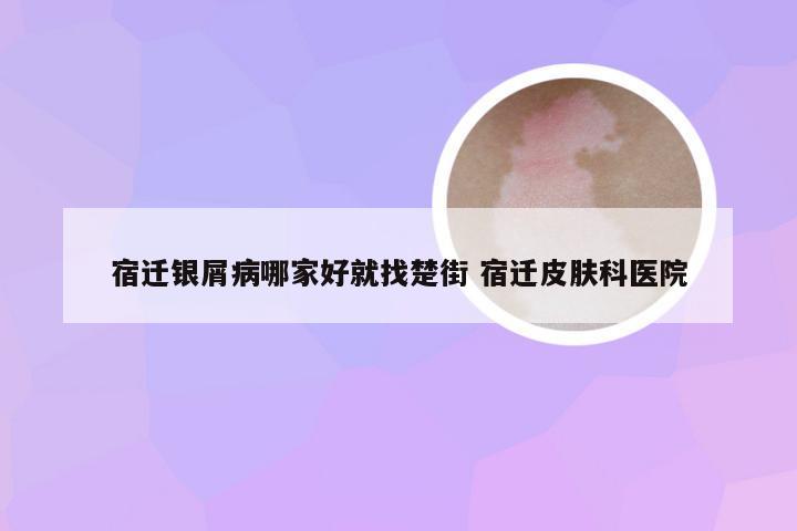 宿迁银屑病哪家好就找楚街 宿迁皮肤科医院