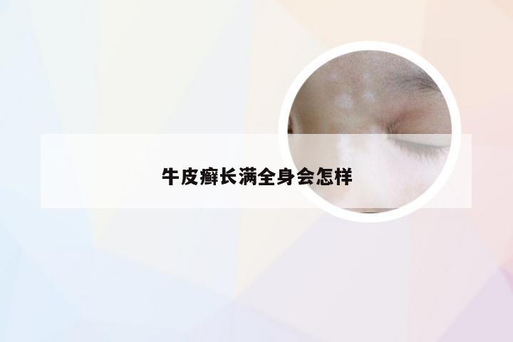 牛皮癣长满全身会怎样